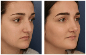 Before and after image of woman who had rhinoplasty surgery from Dr. Schuster, showing no scarring